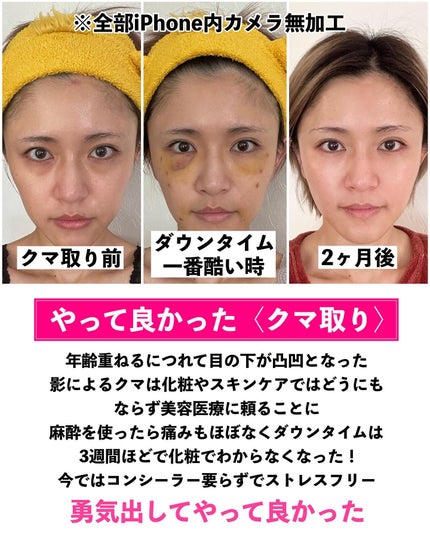 とみりー on LIPS 「36歳がやってよかった美容医療まとめ✨◆───--- - -..」(4枚目)