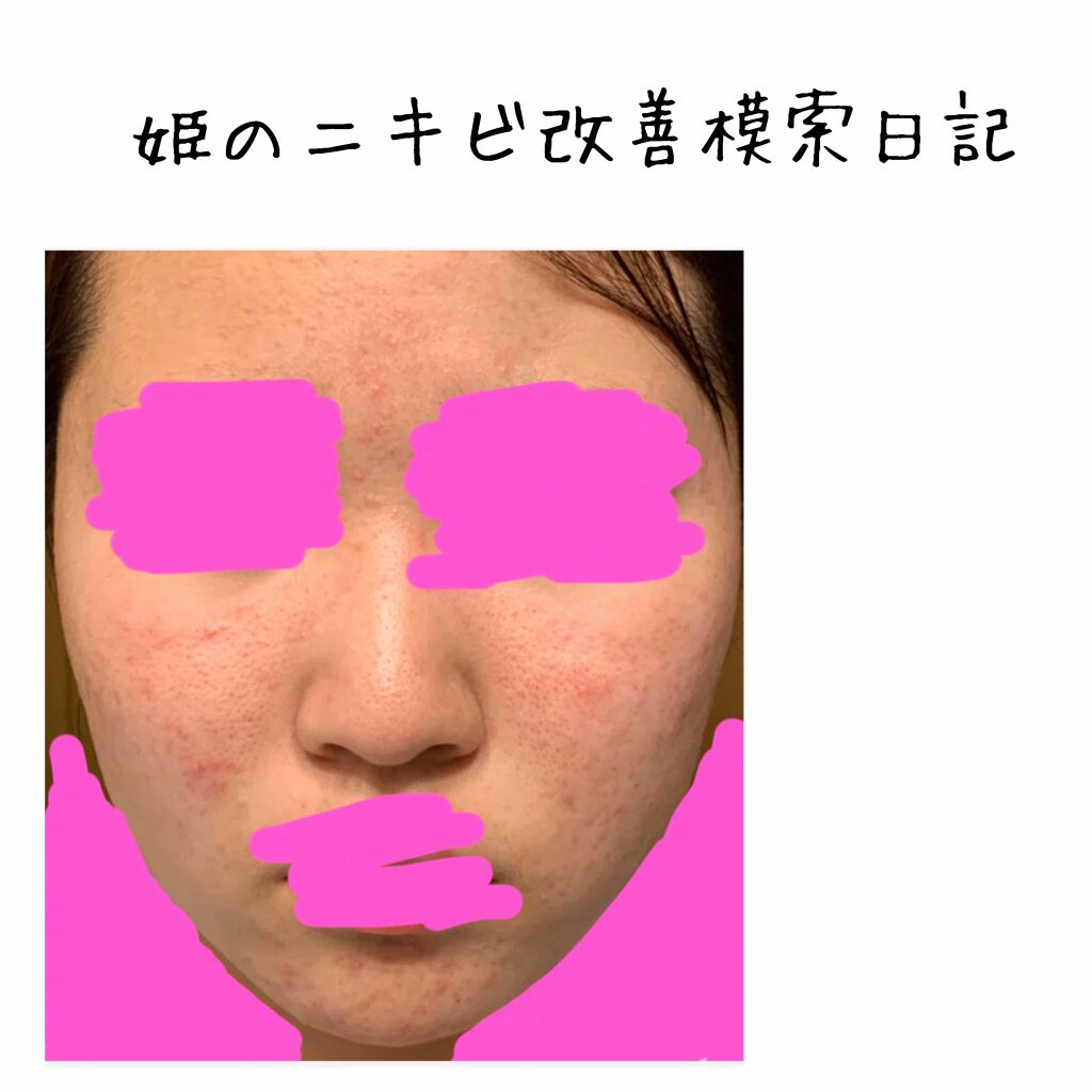 クリンダマイシンゲル(医薬品)/クラシエ薬品/その他を使ったクチコミ（1枚目）