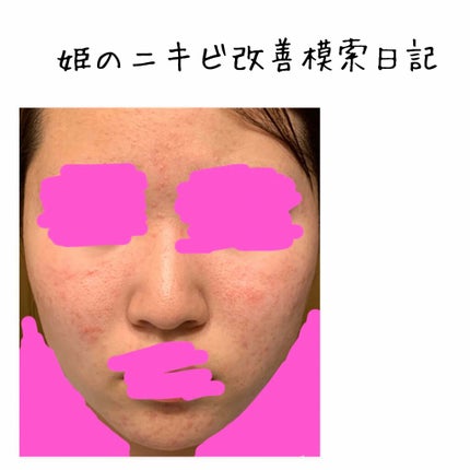 姫 on LIPS 「#姫のニキビ改善模索日記↑もし良かったら見てね良くなってたのに..」(1枚目)