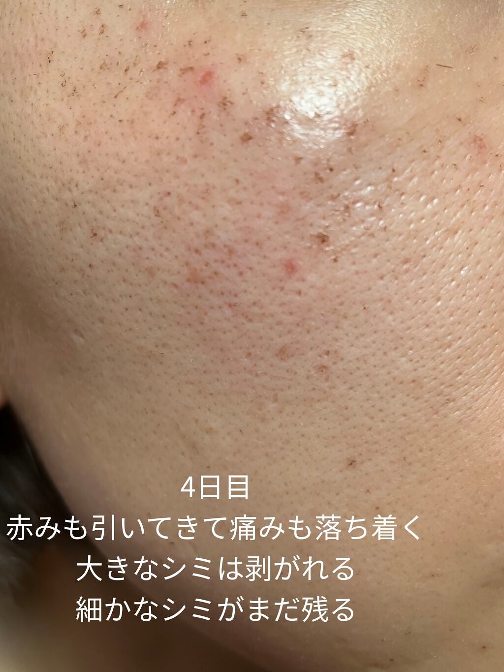 侘助 on LIPS 「【美容医療でシミ取り記録】こんにちは、侘助です❁❁❁今回は美容..」(5枚目)