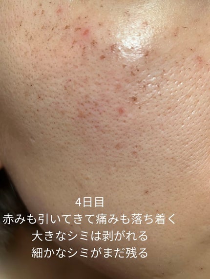 侘助 on LIPS 「【美容医療でシミ取り記録】こんにちは、侘助です❁❁❁今回は美容..」(5枚目)