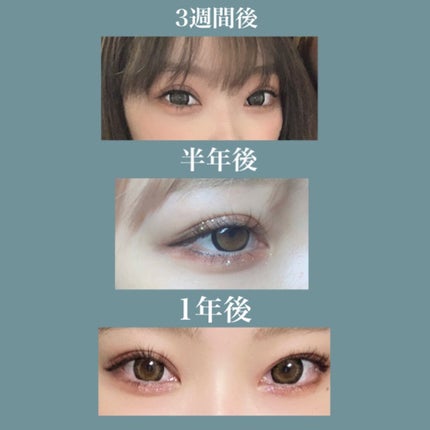 りみ on LIPS 「⚠️一応閲覧注意です⚠️埋没をして、人生が変わりました🌟中高と..」(4枚目)