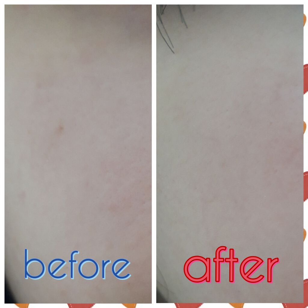 オロナインH軟膏 (医薬品)/オロナイン/その他を使ったクチコミ(2枚目)