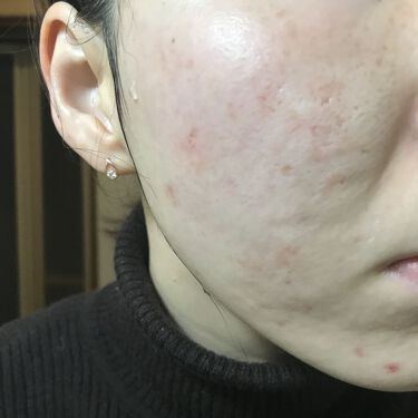 マデカソ 美容液 A Pieuの口コミ 3 18の肌記録 うわっ肌キレイに見える右 By Miina 汚肌工事 フォロバ中 混合肌 Lips マデカソ 美容液 A Pieuの口コミ 3 18の肌記録 うわっ肌キレイに見える右 By Miina 汚肌工事 フォロバ中 混合肌 Lips