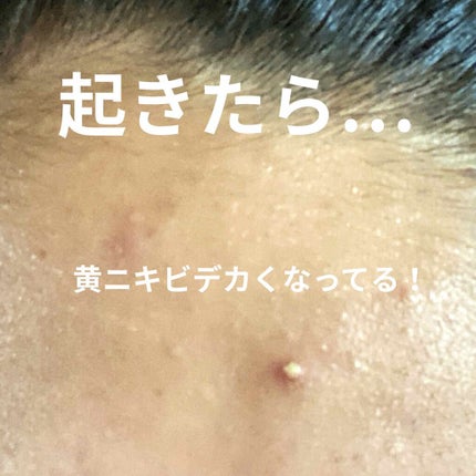 メディカルクリームc(医薬品)/メンソレータム アクネス25/その他を使ったクチコミ(3枚目)