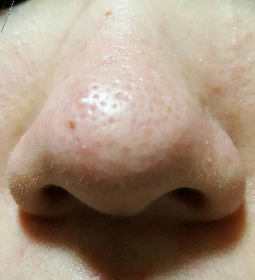 アクア毛穴クリーン/プラソニエ/美顔器・マッサージを使ったクチコミ(3枚目)