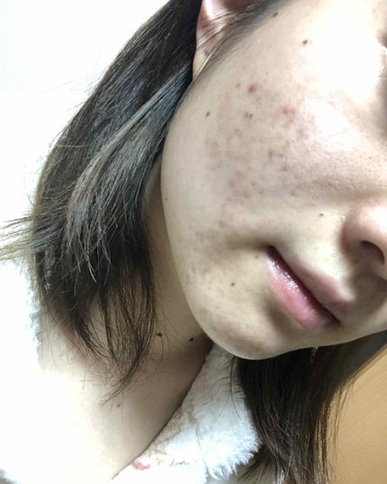 マンスリースキンケアプログラム(旧)/APEX/スキンケアキットを使ったクチコミ(3枚目)