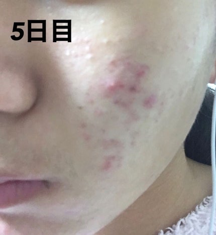 ティーツリーケアソリューション アンプルマスクJEX/MEDIHEAL/シートマスク・パックを使ったクチコミ(2枚目)