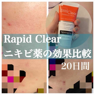 Rapid Clear Stubborn Acne DailyLeave-On Mask/Neutrogena/その他スキンケアを使ったクチコミ（1枚目）