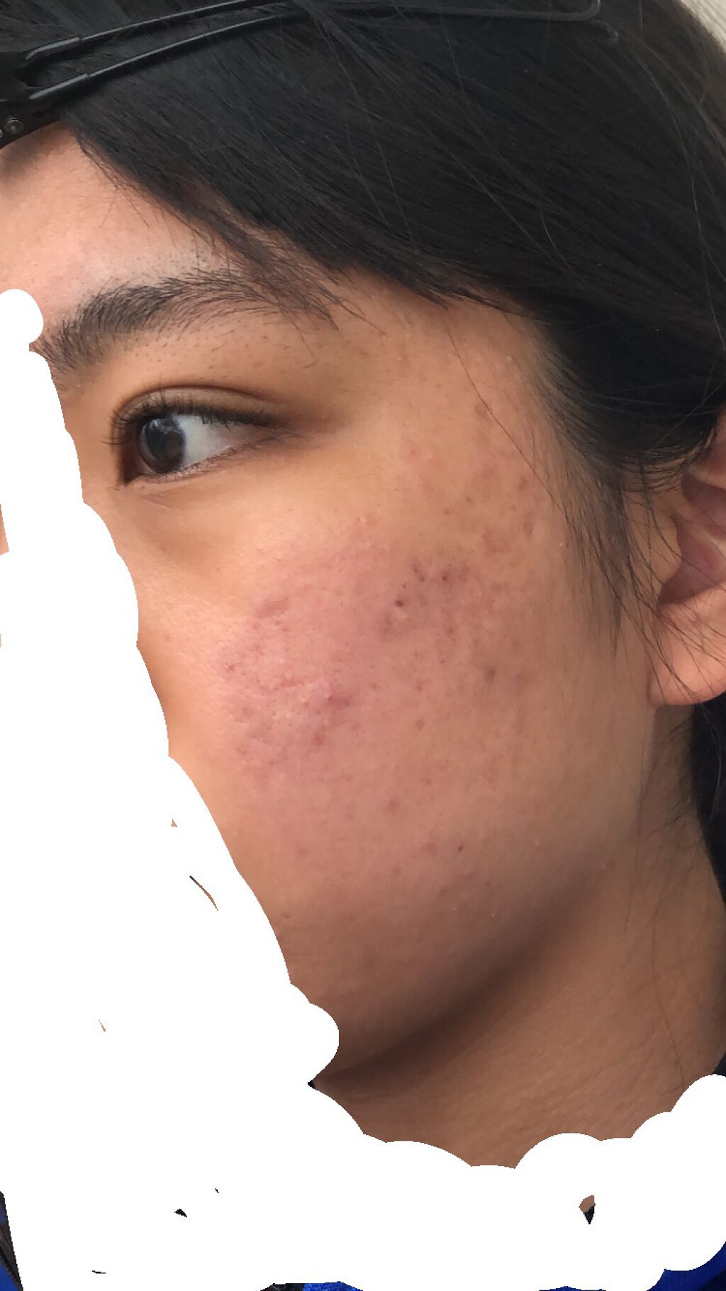 にき子 on LIPS 「【ニキビ治療記録】本当に久しぶりの登校となってしまいすみません..」(1枚目)