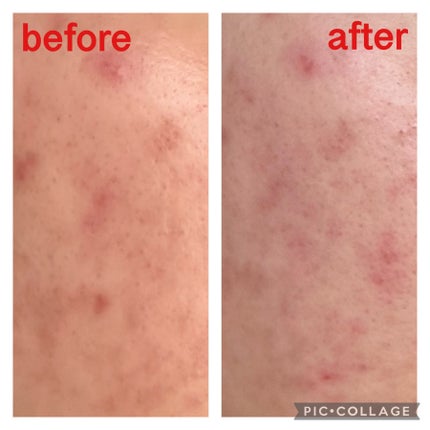 レッドアクネピーリングセラム/MEDICUBE/美容液を使ったクチコミ(8枚目)