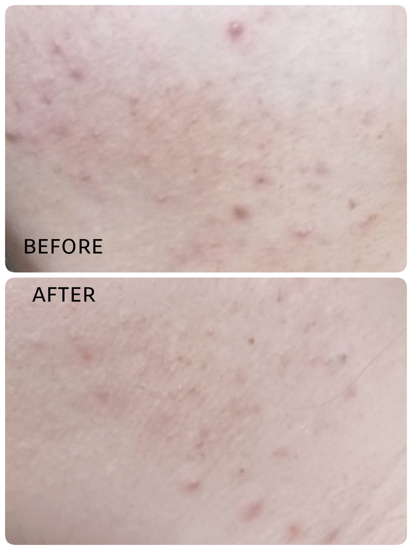 薬用しみ集中対策 プレミアム美容液/メラノCC/美容液を使ったクチコミ(1枚目)