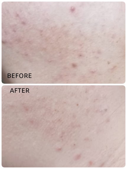 薬用しみ集中対策 プレミアム美容液/メラノCC/美容液を使ったクチコミ(1枚目)