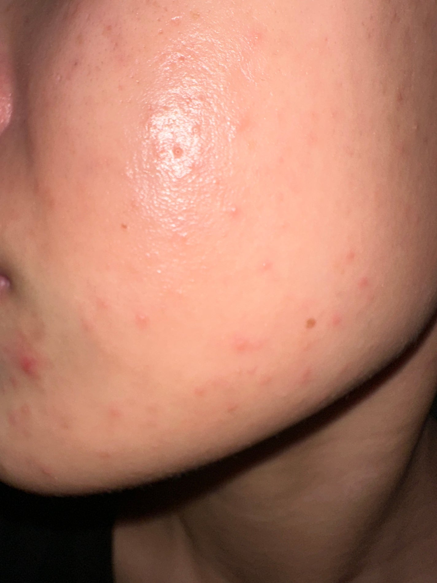 リードルショット700/VT/美容液を使ったクチコミ(2枚目)