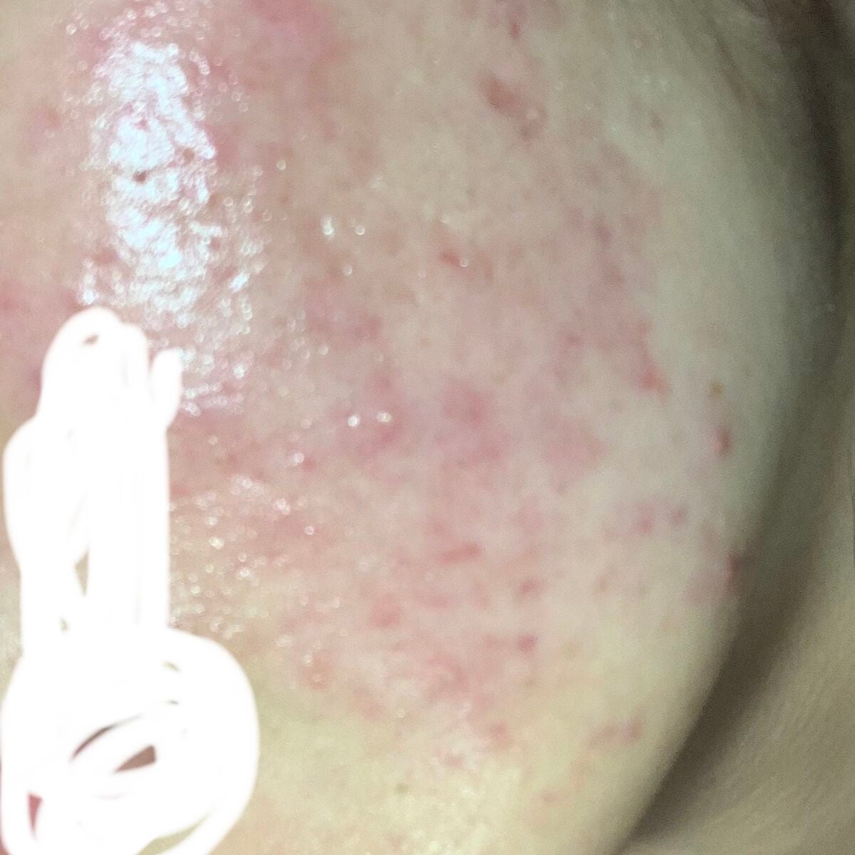 ほるもん on LIPS 「助けてください!!!!😭ニキビ跡の赤み、クレーターになってるの..」(2枚目)