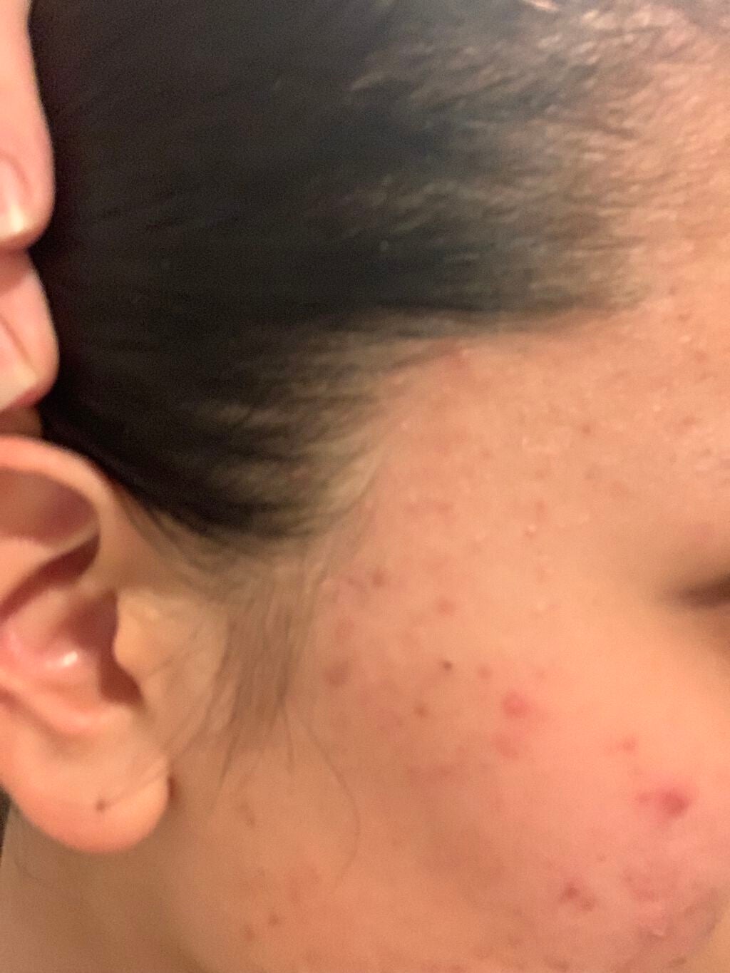 モモ on LIPS 「前の投稿消してしまったので、再度載せ直し🎞肌荒れし放題の肌を治..」(3枚目)