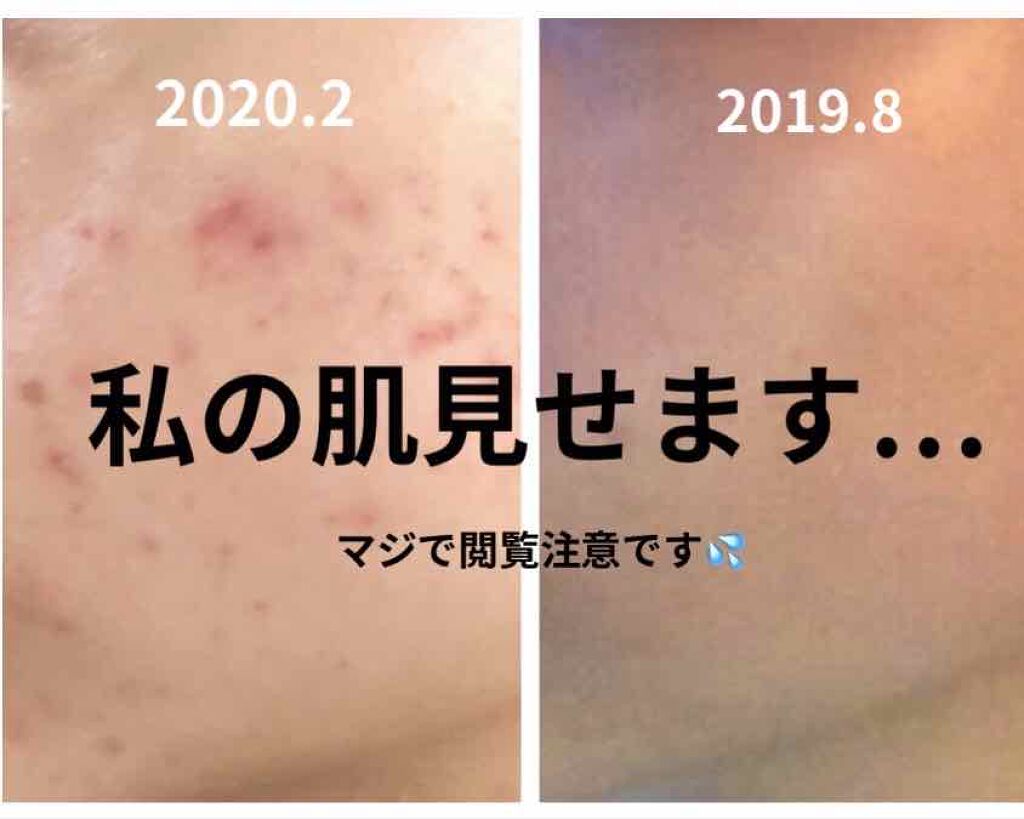 **むぎちゃん** on LIPS 「なぜ私が肌荒れしたのかおはようございます☀︎私自身、自分の肌荒..」(1枚目)