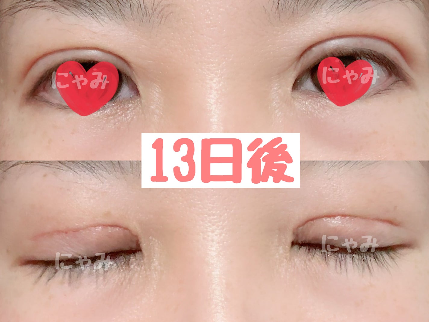 にゃみー★フォロバ投稿ある方 on LIPS 「【二重全切開+たるみ取りレポ】施術から2週間経ちました。今のと..」(2枚目)
