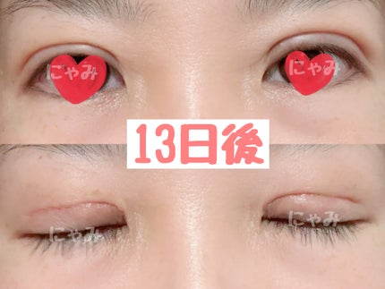 にゃみー★フォロバ投稿ある方 on LIPS 「【二重全切開+たるみ取りレポ】施術から2週間経ちました。今のと..」(2枚目)