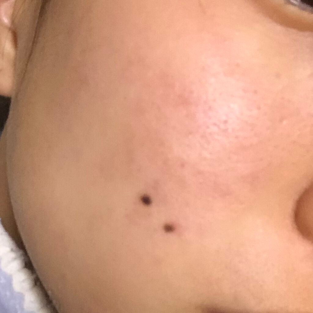 えりか on LIPS 「助けてくださいマスクをするようになって、肌荒れがなかなかなおら..」(3枚目)