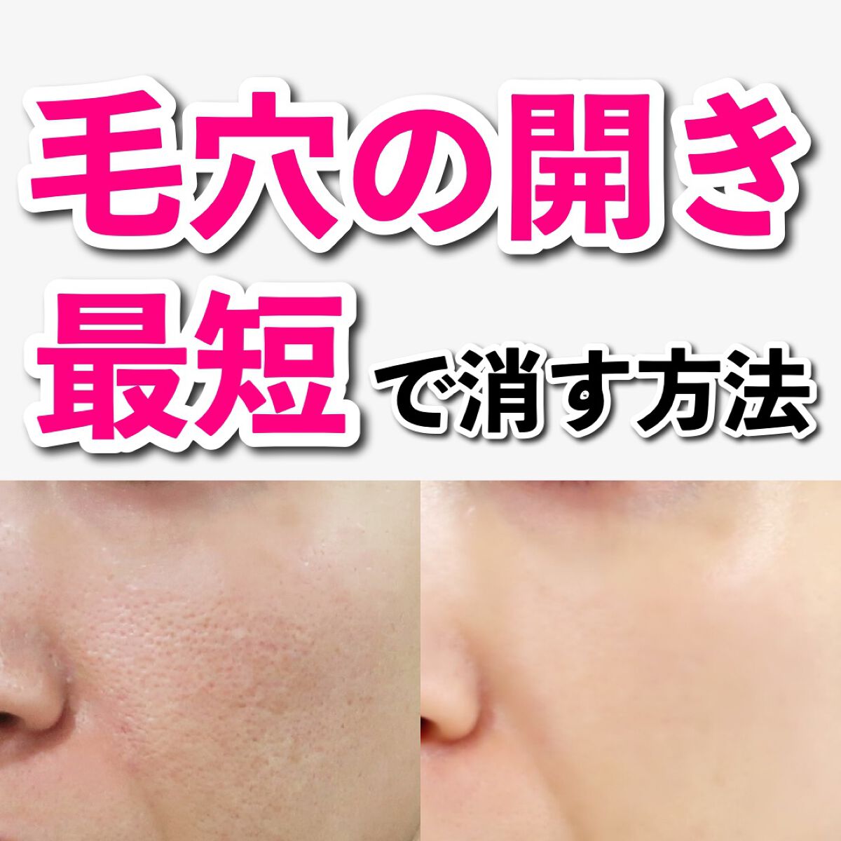 あなたの肌に合ったスキンケア💐コーくん先生 on LIPS 「【効きすぎ注意】毛穴の開き最短で消す方法.
.
あなたの毛穴悩..」(1枚目)