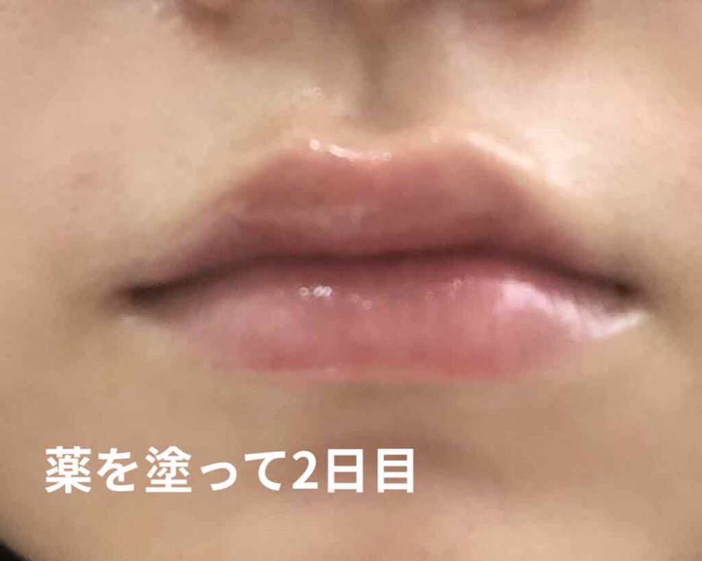 試してみた プロペト 医薬品 丸石製薬の商品情報 通販 Lips 試してみた プロペト 医薬品 丸石製薬の商品情報 通販 Lips
