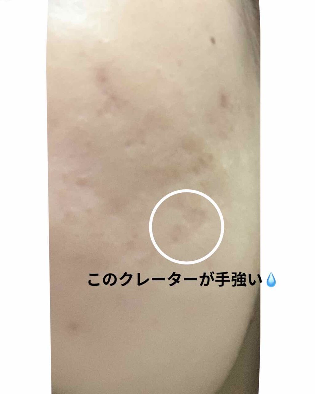 Cちゃん on LIPS 「ダーマペン 4ヶ月半 経過お久しぶりです✌️地道にダーマペンを..」(4枚目)