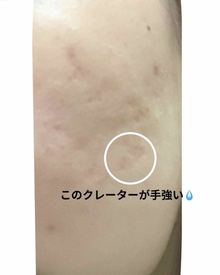 Cちゃん on LIPS 「ダーマペン 4ヶ月半 経過お久しぶりです✌️地道にダーマペンを..」(4枚目)