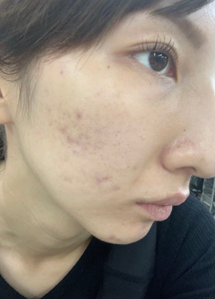 VC100エッセンスローション EX/ドクターシーラボⓇ/化粧水を使ったクチコミ(1枚目)