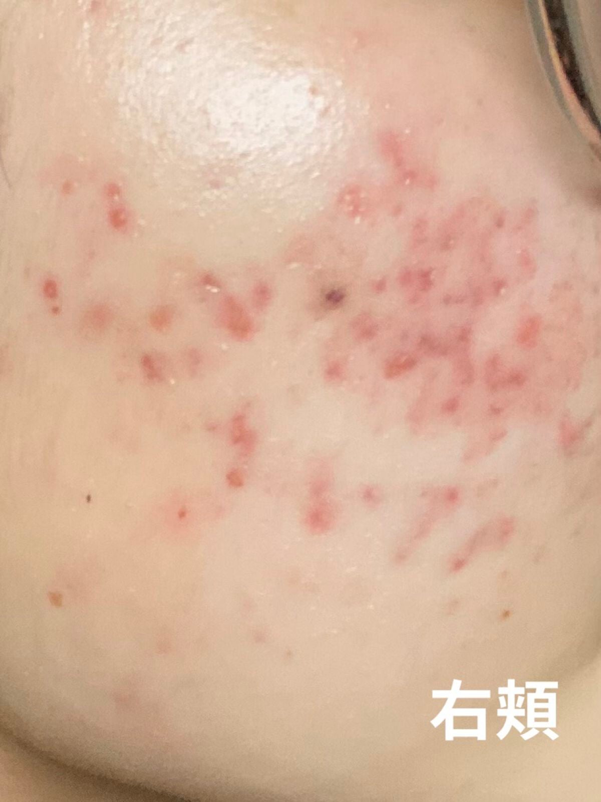 薬用 しみ 集中対策 美容液/メラノCC/美容液を使ったクチコミ(3枚目)