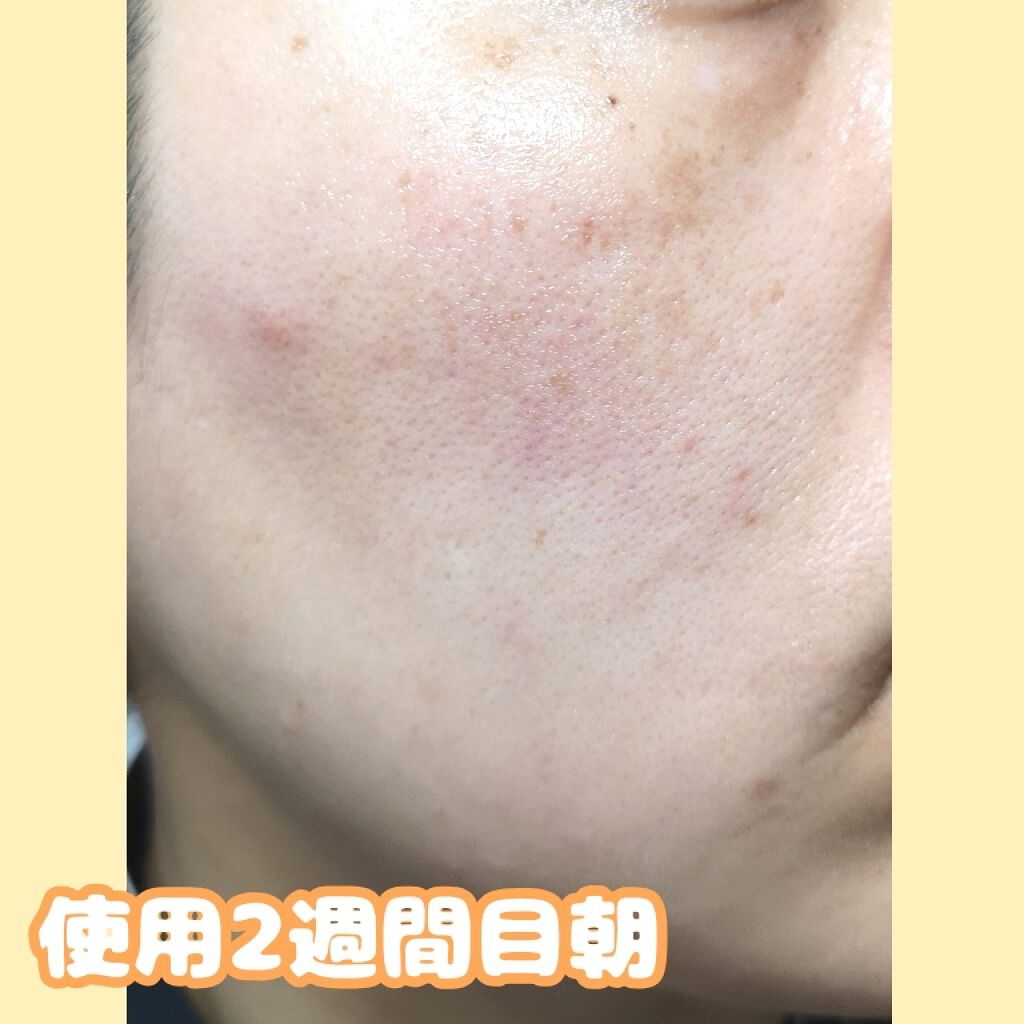 アレルバリア エッセンス BB/d プログラム/BBクリームを使ったクチコミ（2枚目）