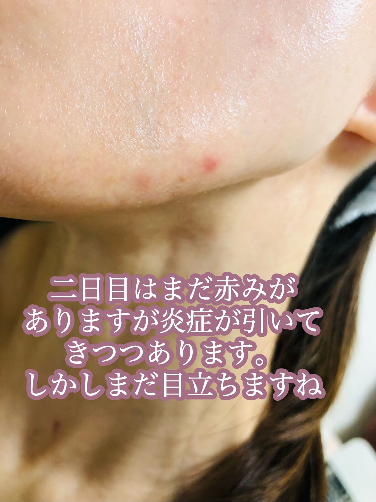 プロCICA クリアスポットパッチ/VT/その他スキンケアを使ったクチコミ(2枚目)