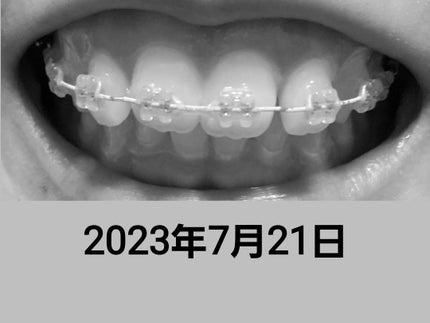 デンタルラボ マウスピース・矯正用リテーナー用洗浄剤/アース製薬/その他オーラルケアを使ったクチコミ(4枚目)
