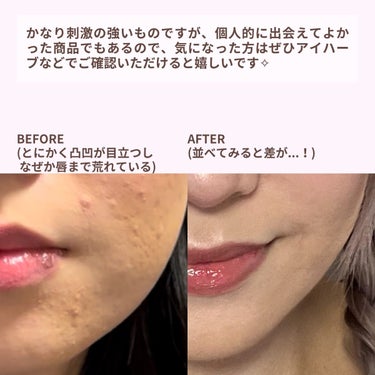 Glucolic Acid 30% Gel Peel/YEOUTH/ピーリングを使ったクチコミ（6枚目）