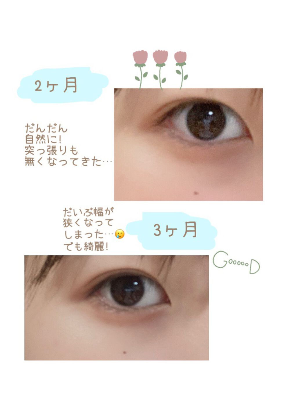 くるり on LIPS 「二重整形埋没について私は5か月前までものっっすごく重い一重でし..」(3枚目)