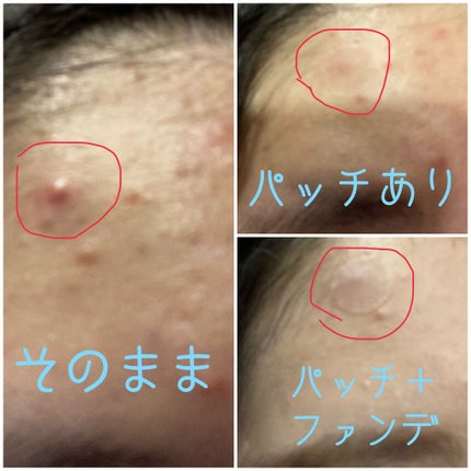 クリアパッチ/Angelab/にきびパッチを使ったクチコミ(2枚目)