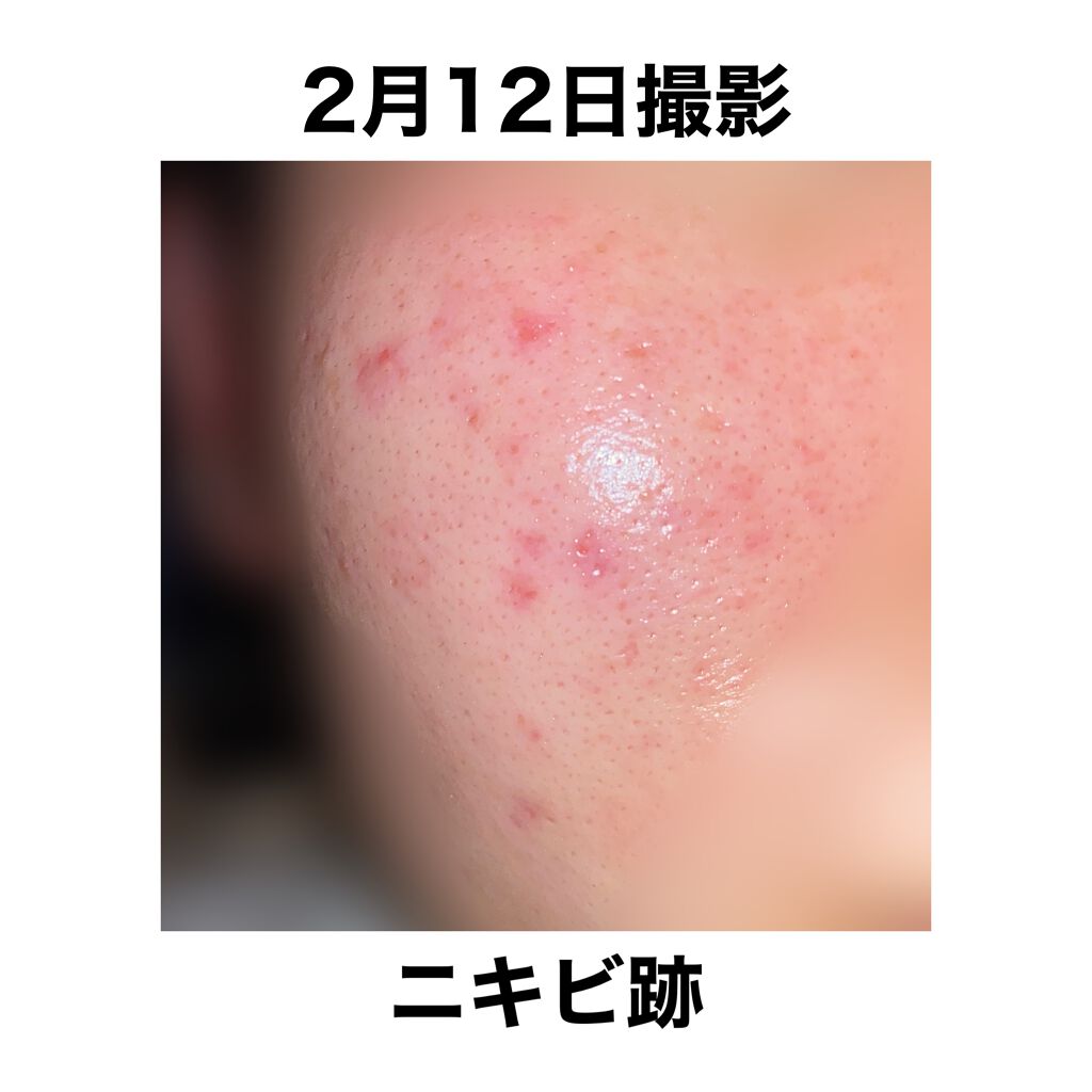 薬用 しみ 集中対策 美容液/メラノCC/美容液を使ったクチコミ(2枚目)