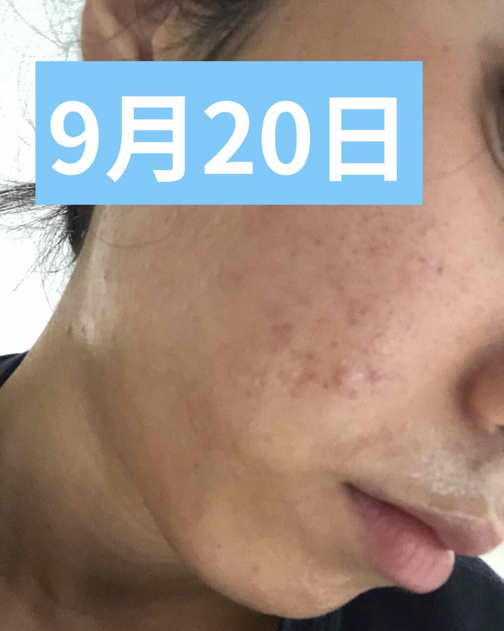 ペアアクネクリームW(医薬品)/ペア/その他を使ったクチコミ（2枚目）