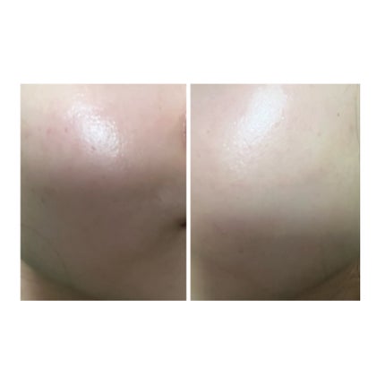 ぽむ on LIPS 「2023.9.13皮膚科に受診 エピデュオとヘパリン処方1枚目..」(5枚目)