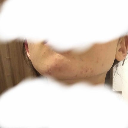 ペアアクネクリームW(医薬品)/ペア/その他を使ったクチコミ(3枚目)