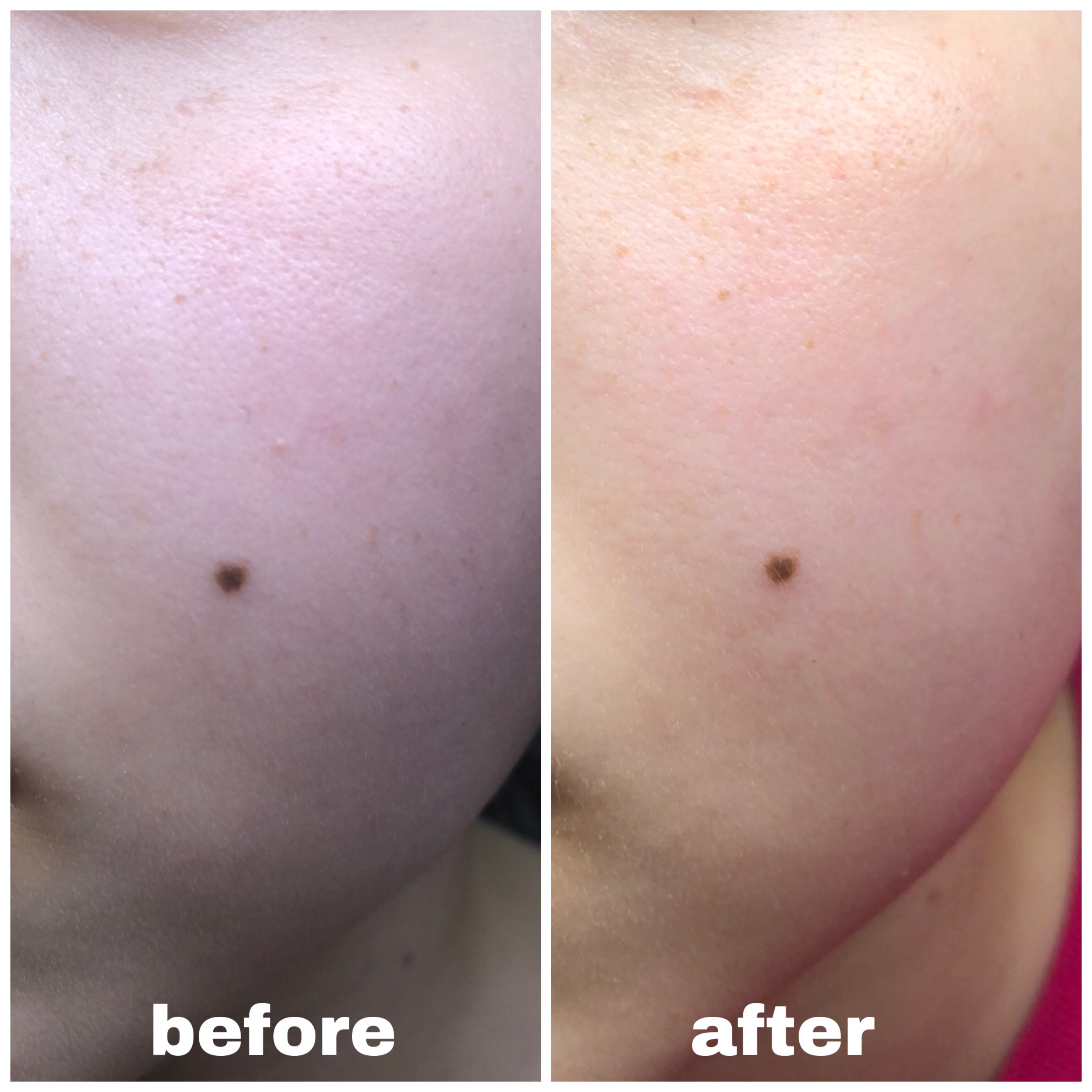 シカレチA クリーム0.05/VT/フェイスクリームを使ったクチコミ（3枚目）