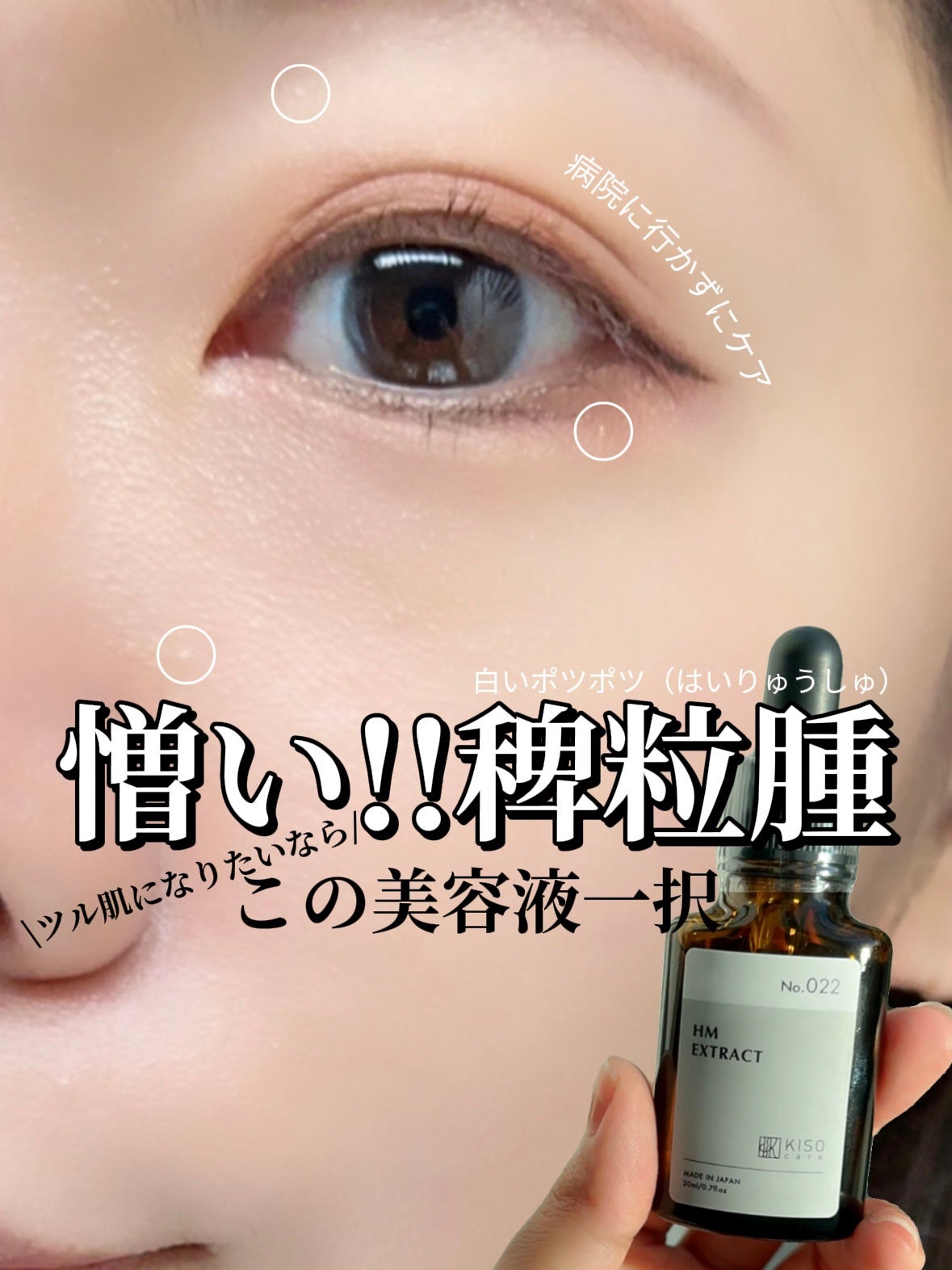 イエベの美肌マニアnaomi on LIPS 「稗粒腫を美容液でケア/白いポツポツ繰り返し出来る!!
名前は稗..」(1枚目)