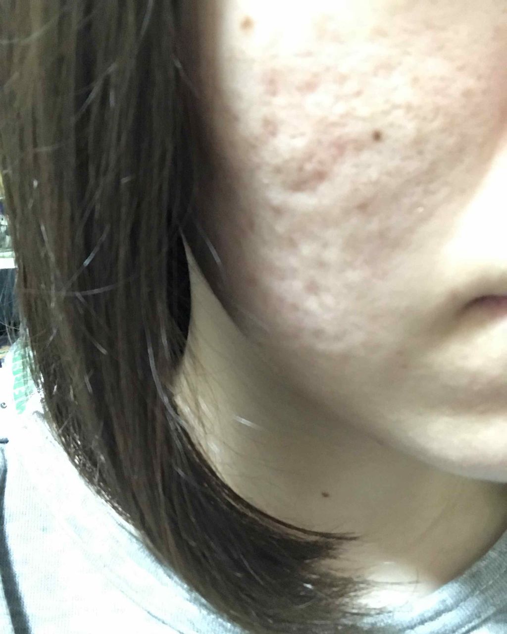 経過観察用 on LIPS 「中学の頃からニキビができまくって潰した結果自業自得の肌に。ビー..」(3枚目)