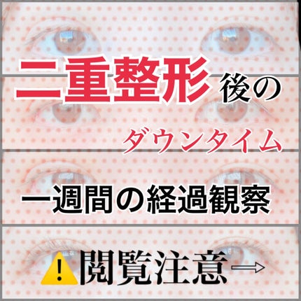 二重整形/その他を使ったクチコミ(1枚目)