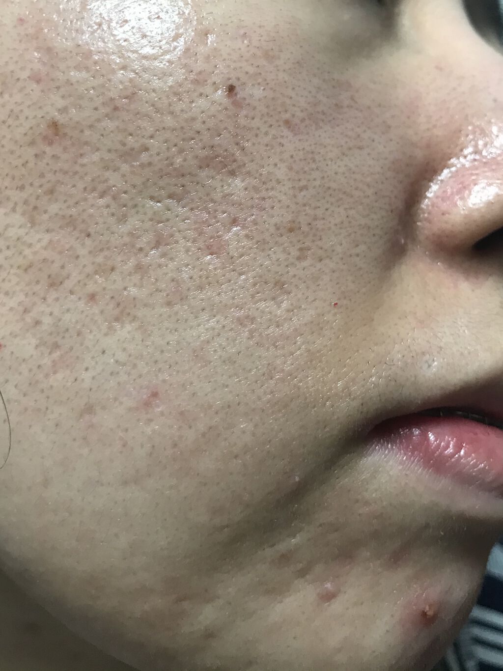 メディカルクリームc(医薬品)/メンソレータム アクネス25/その他を使ったクチコミ（1枚目）