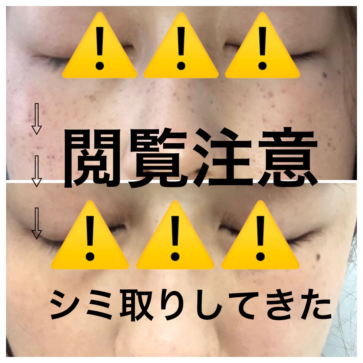 enu on LIPS 「シミ取り(ルメッカ)してきました〜❤︎.*ずーと悩んでいたシミ..」(1枚目)