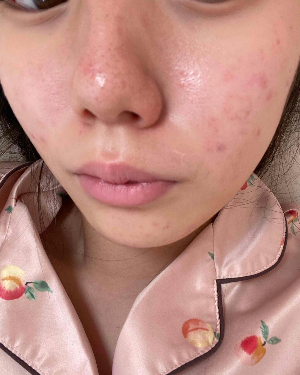 mo on LIPS 「ニキビ治りません皮膚科に行ってもダメでした色んな薬使いましたが..」(2枚目)