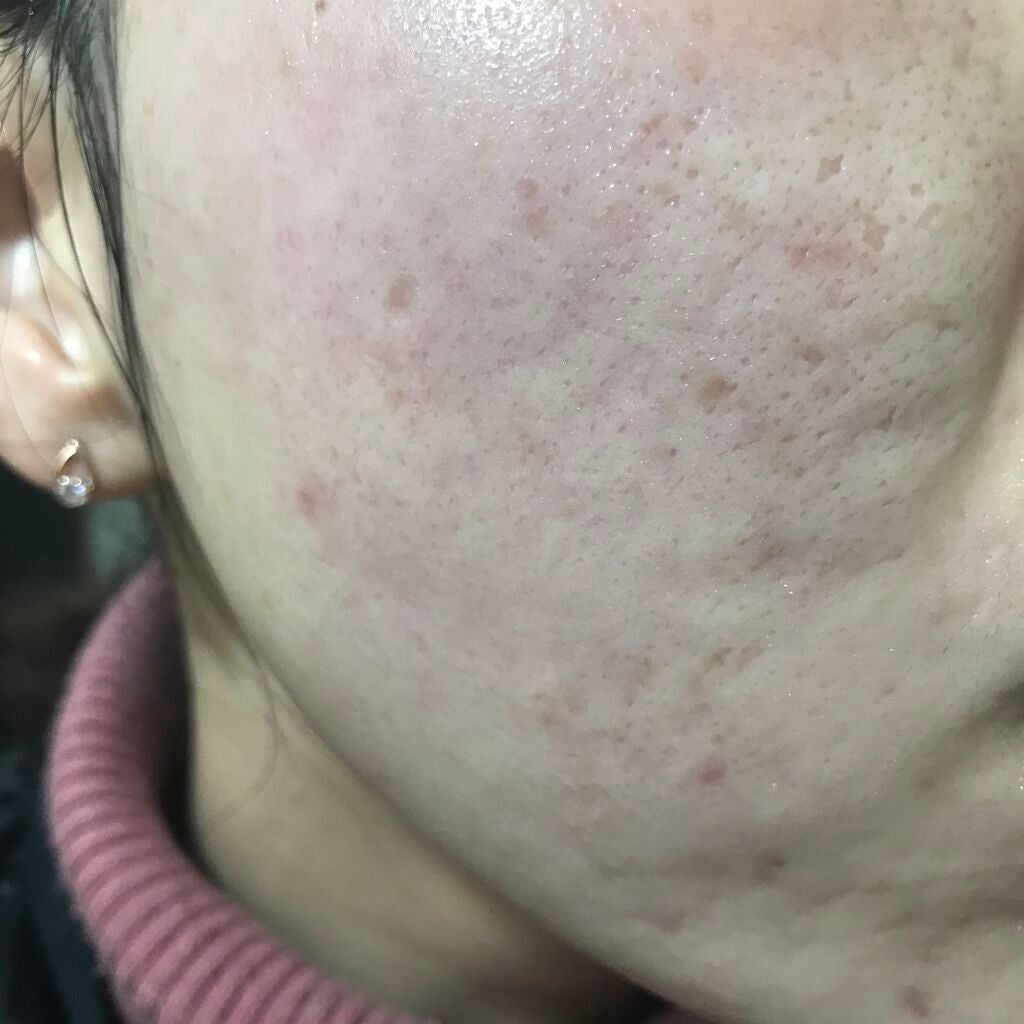 ティーツリーケア ソリューション エッセンシャルマスクEX/MEDIHEAL/シートマスク・パックを使ったクチコミ(1枚目)