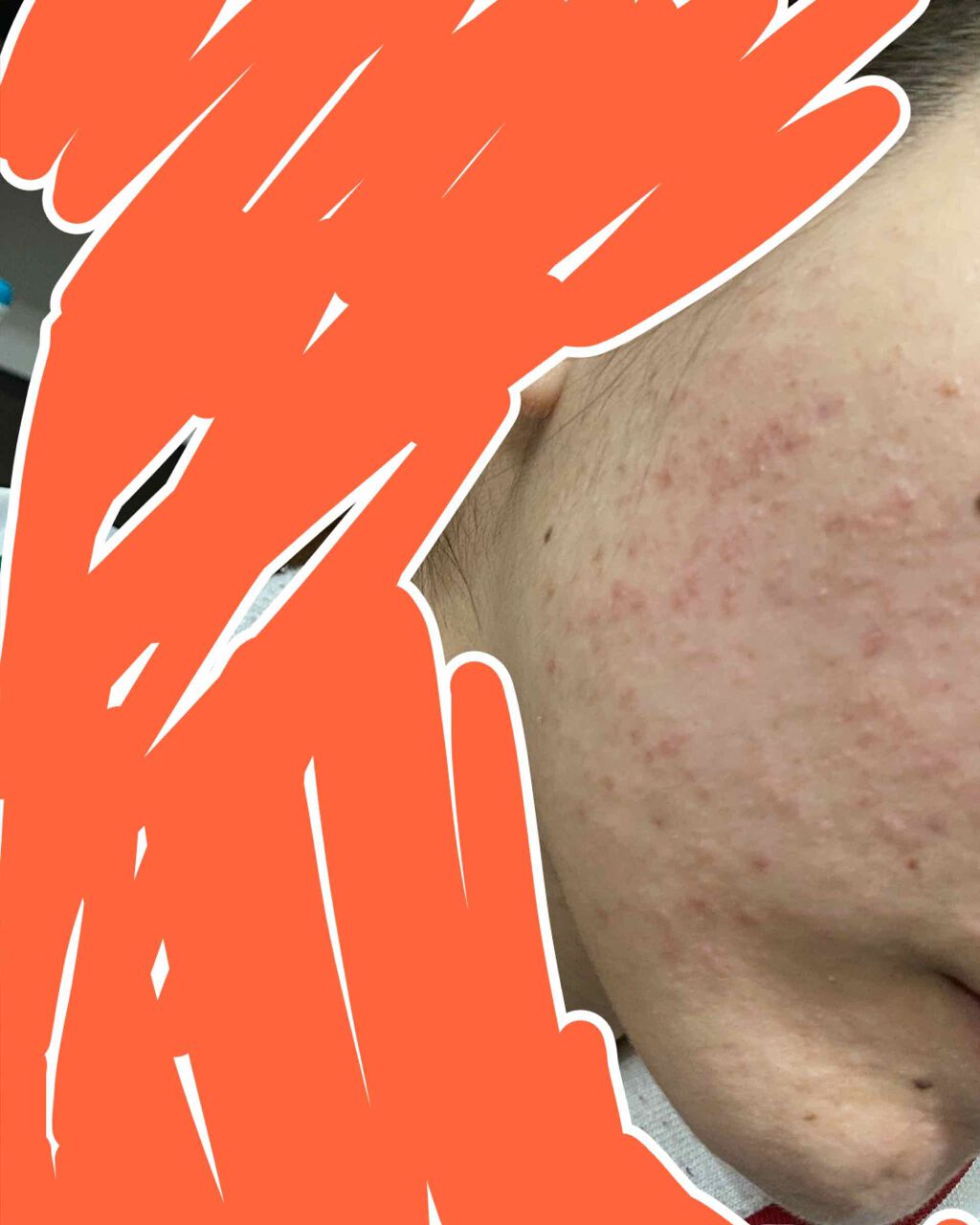 ベピオゲル/マルホ株式会社/その他を使ったクチコミ（3枚目）