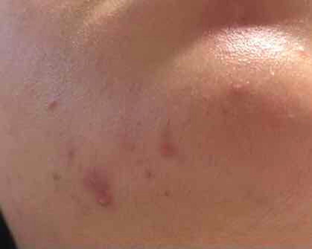 薬用保湿化粧水/オードムーゲ/化粧水を使ったクチコミ(5枚目)